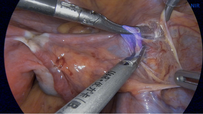 宮頸癌內(nèi)膜癌外陰癌前哨淋巴結(jié)示蹤